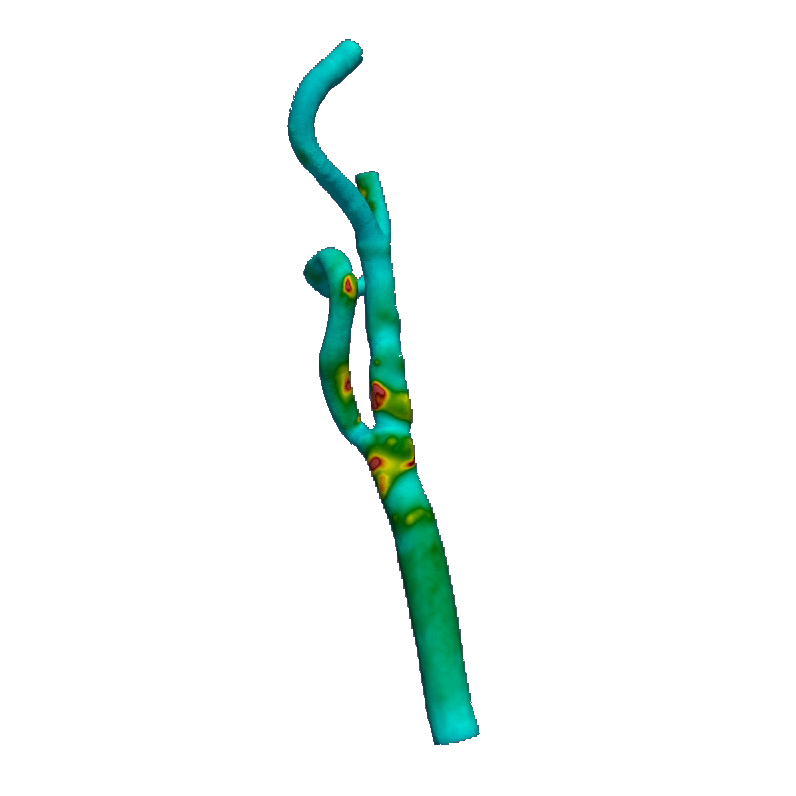 Carotid stenosis simulation using NeuroCFD